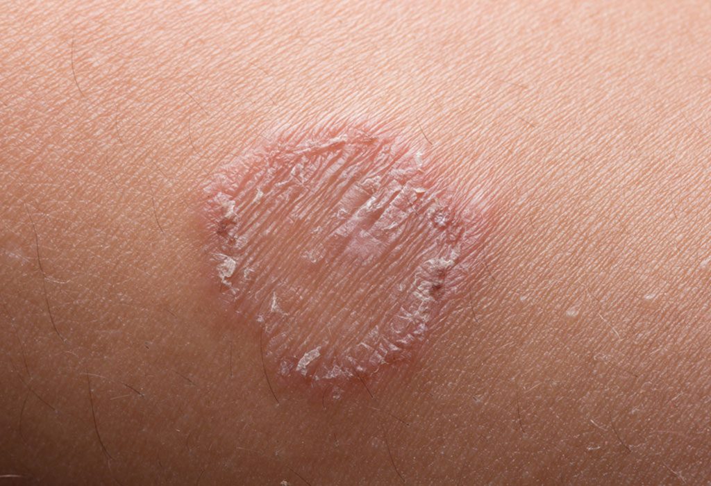 Ringworm in Babies: Causes, Symptoms & Treatment