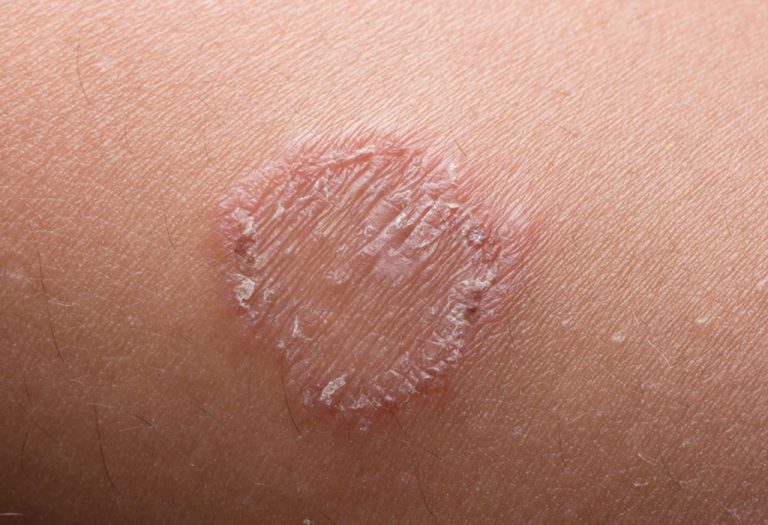 Ringworm in Babies: Causes, Symptoms & Treatment