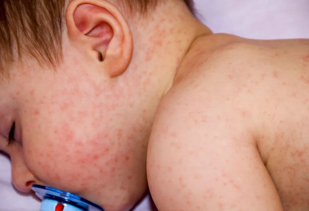 Skin Rashes In Children: Causes And Treatment