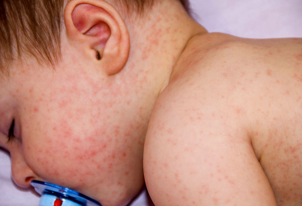 Baby Skin Allergies Reasons Signs Treatment