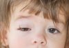 शिशुओं और बच्चों में कंजंक्टिवाइटिस (पिंक आई)