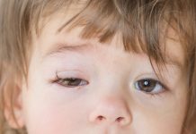 शिशुओं और बच्चों में कंजंक्टिवाइटिस (पिंक आई)
