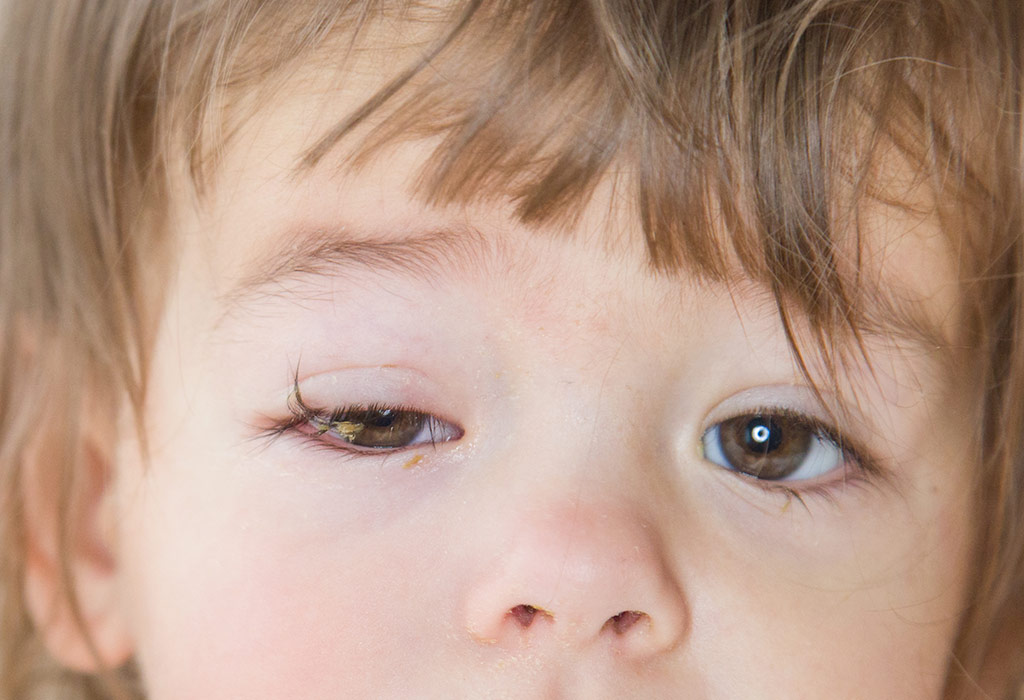 Pink Eye In Kids