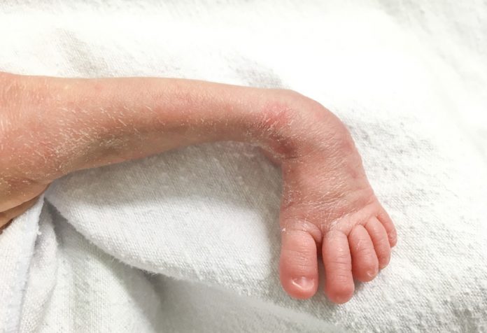 Clubfoot (Talipes) In Babies