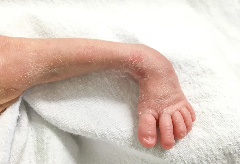 Newborn Baby Foot Problems and Deformities