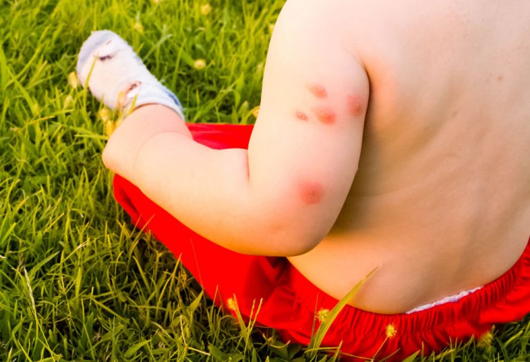 How To Treat The Mosquito Bites On Your Baby