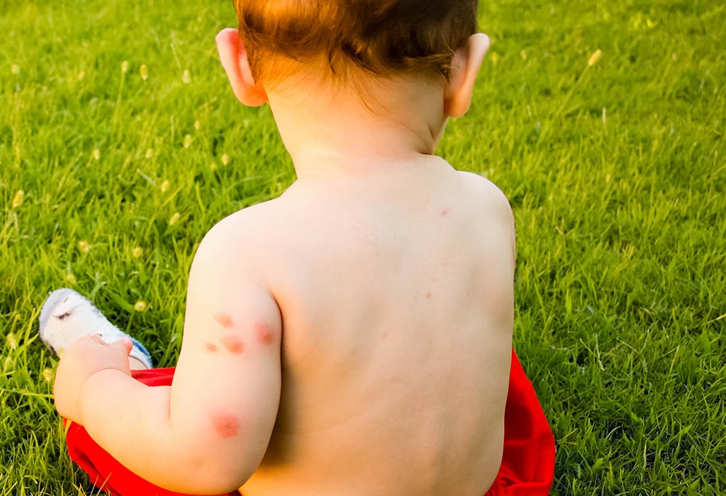 Hives symptoms in child