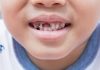 बच्चों में दांतों की सड़न: कारण, लक्षण और इलाज
