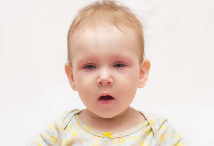 An unwell baby with red eyes