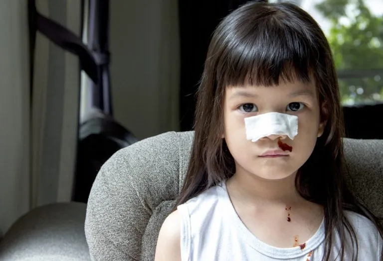 Nose Bleeding in Children