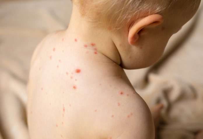 Measles(Rubeola) in Children