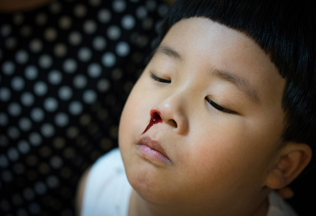 बच्चे में नाक से खून आना कैसे रोकें