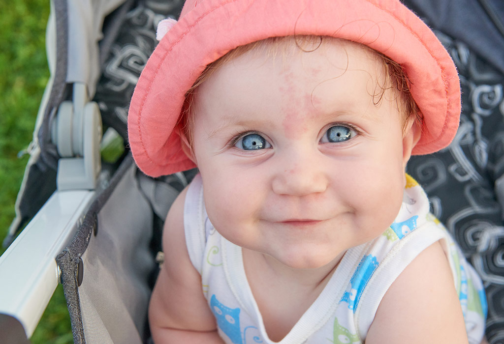 Birthmarks In Babies Types Causes Treatment