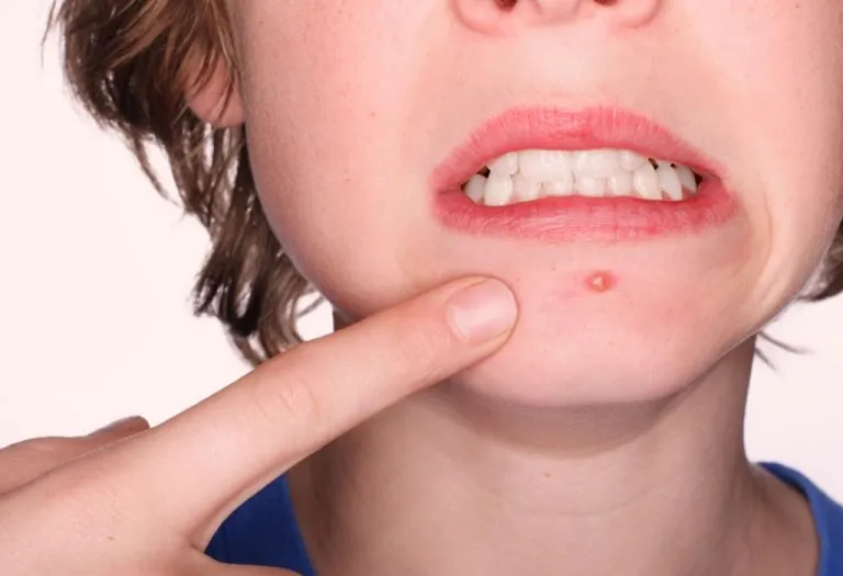 How to Treat Boils and Painful Bumps During Pregnancy
