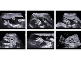 গর্ভাবস্থায় অ্যানোমালি স্ক্যান