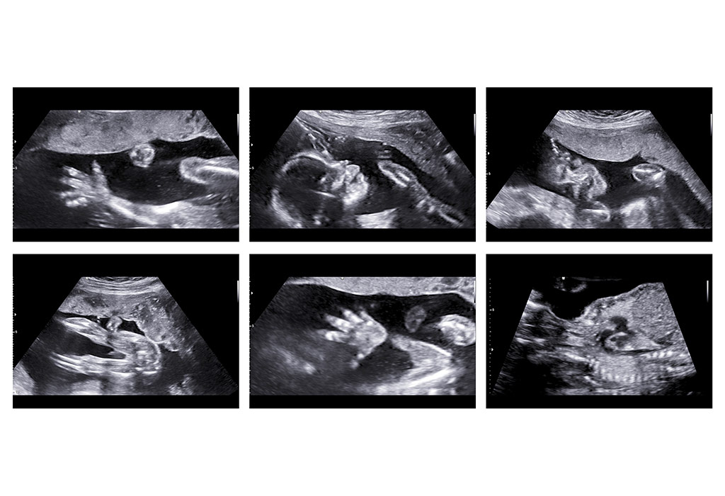 Anomaly Scan During Pregnancy