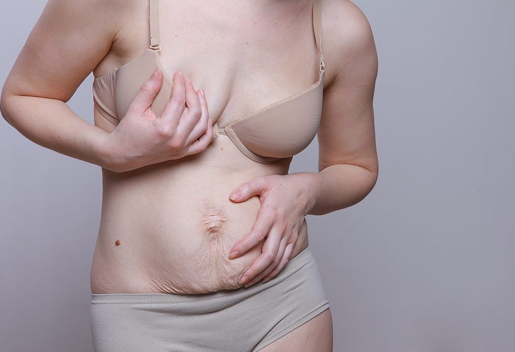 Diastasis Recti (Abdominal Wall Separation) After Pregnancy