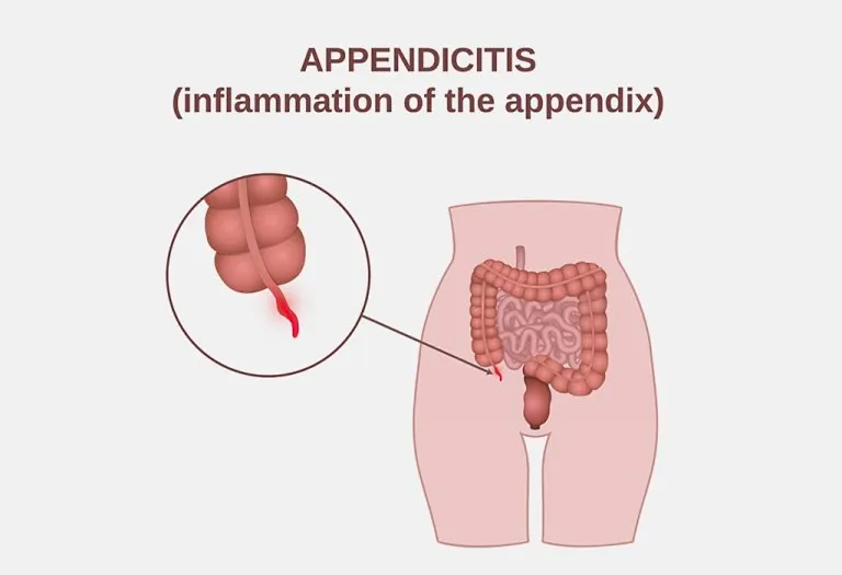 Appendicitis in Pregnancy