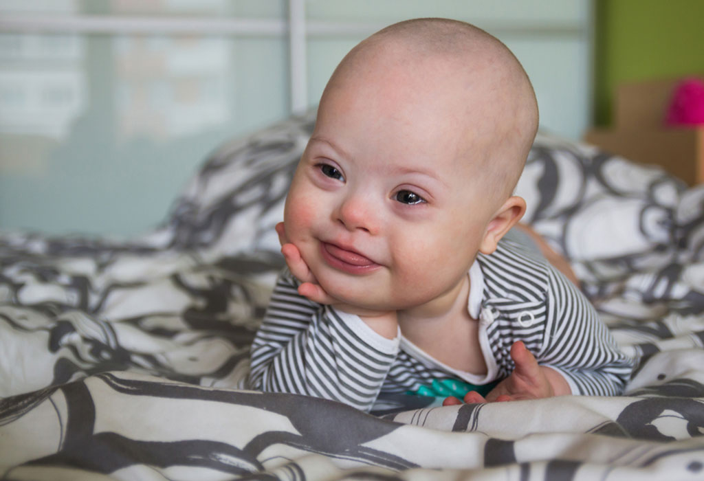 Baby With Down Syndrome Types Causes Treatment