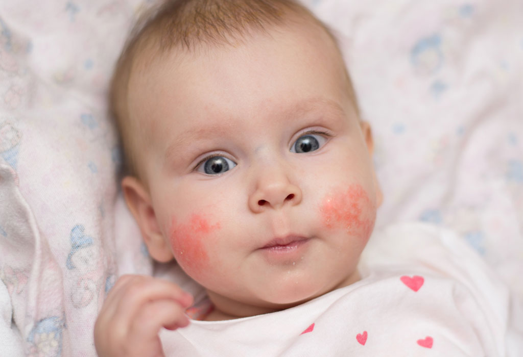 Allergy rash baby treatment