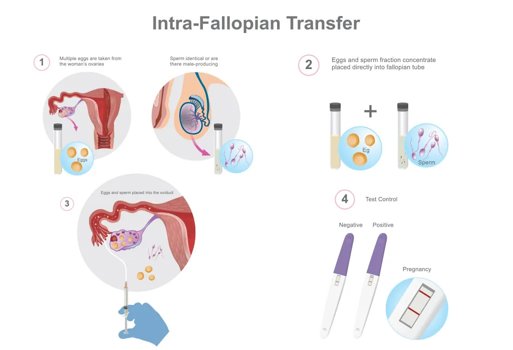 An educational infographic of the gamete intra-fallopian process