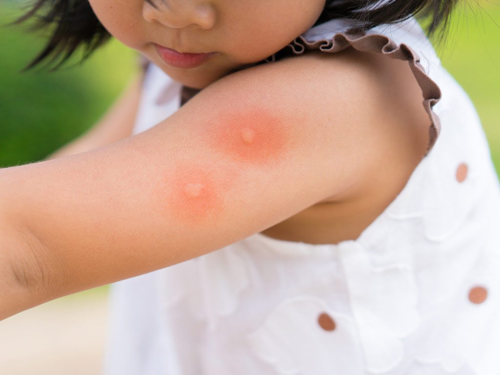 Dengue in Children – Signs, Diagnosis &  Treatment