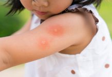 बच्चों में डेंगू - संकेत, पहचान और इलाज