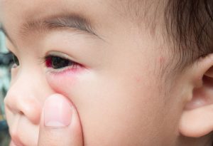 Un bambino con un occhio rosso e gonfio