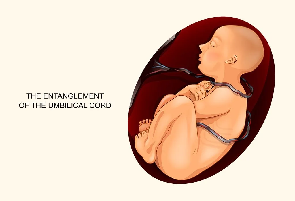 Umbilical Cord around Neck: Causes, Signs & Remedies