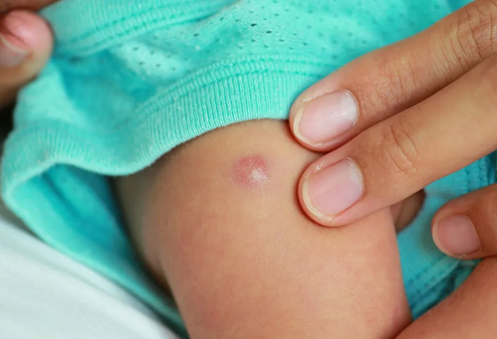 A baby with a blister on the shoulder A baby with a blister on the shoulder