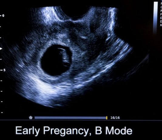 ক্রাউন-রাম্প লেন্থ (CRL) পরিমাপের চার্ট