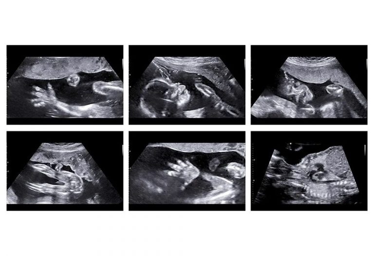 Anomaly Scan in Pregnancy