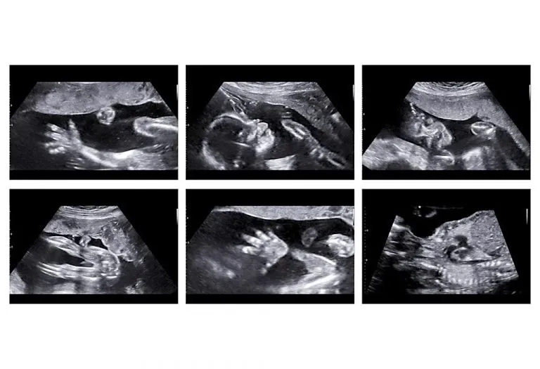 Anomaly Scan in Pregnancy