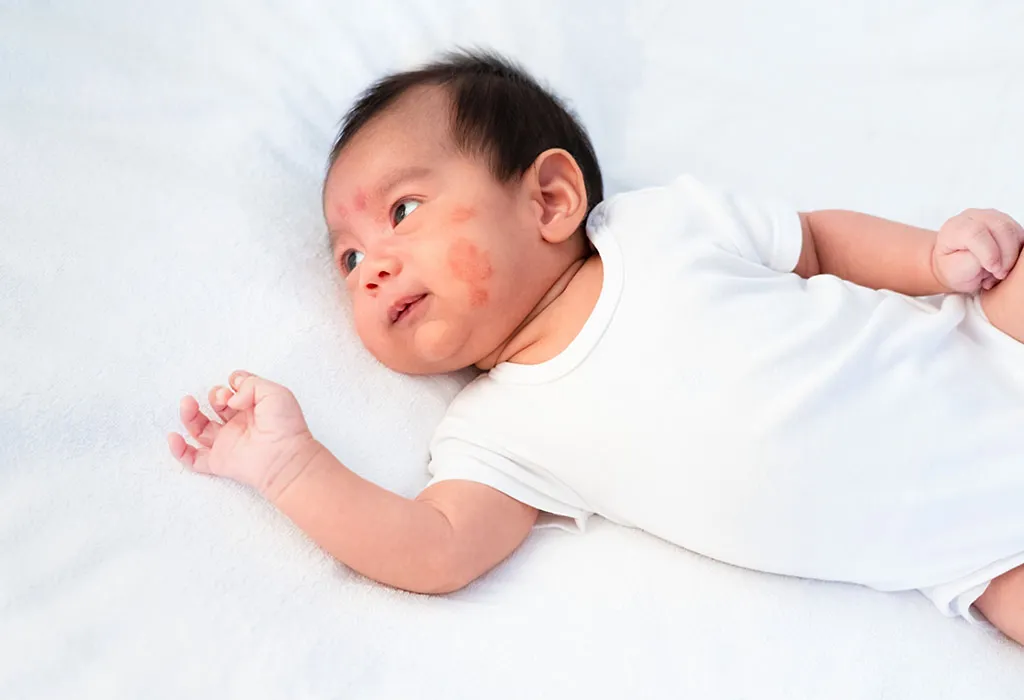 Atopic Eczema