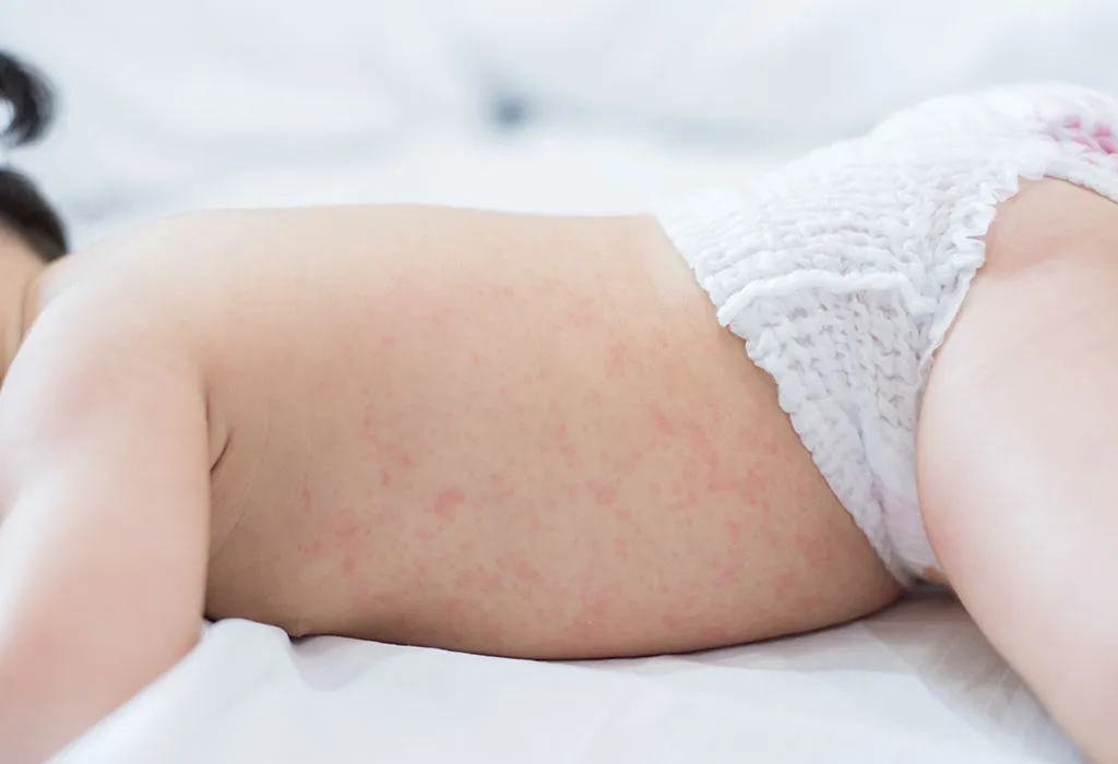 Miliaria or Heat Rash