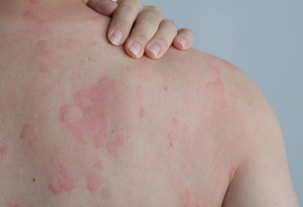 Hives