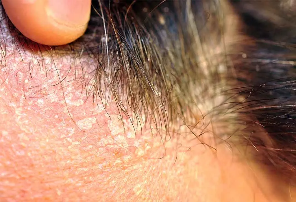Seborrheic Dermatitis