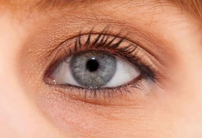 Dark Circles Under Eyes in Kids - Causes and Treatment