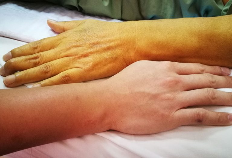 Jaundice in Pregnancy: Causes, Symptoms, & Treatments