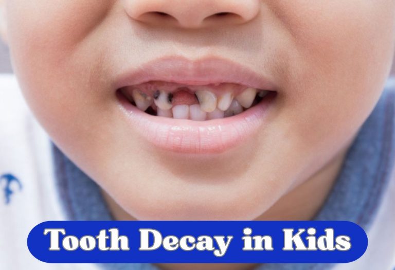 Tooth Decay (Caries or Cavities) in Kids: Causes, Signs, & Treatment