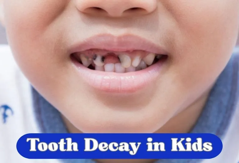 Tooth Decay (Caries or Cavities) in Kids: Causes, Signs, & Treatment