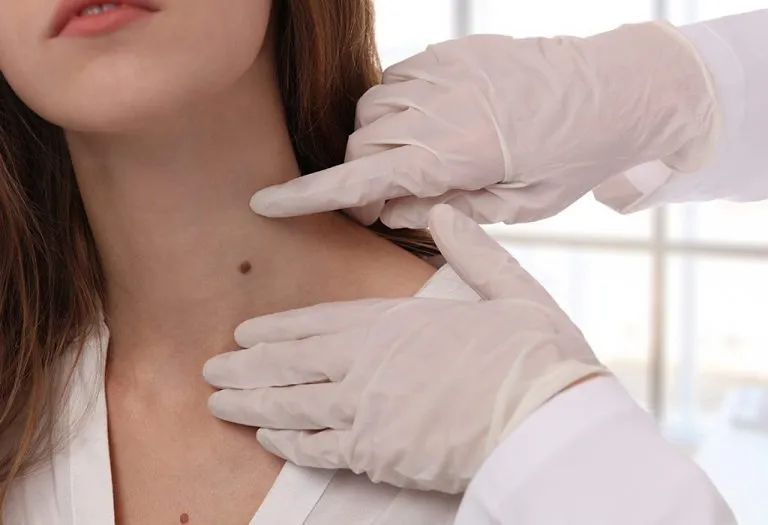 Skin Tags During Pregnancy: Causes, Risk and Treatment