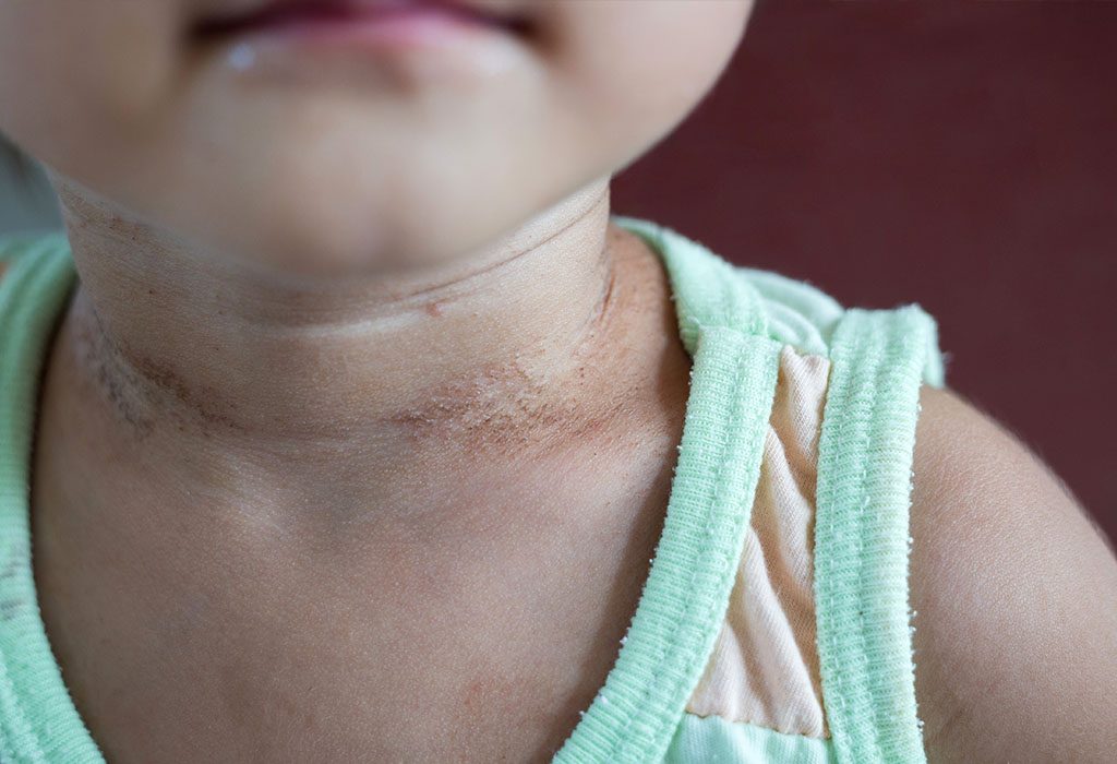 Neck Rash In Babies Reasons Symptoms Treatment Home Remedies