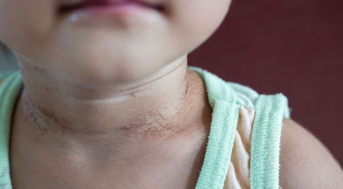 10 Tips On How To Remove Hair Dye Or Colour Stains From Skin