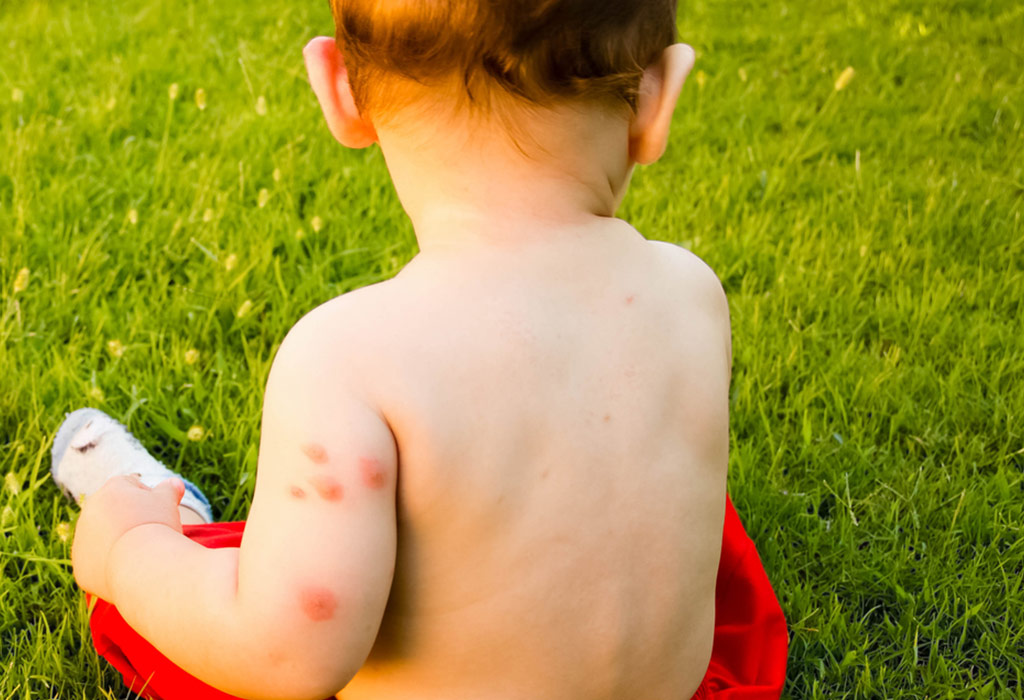 Insect bites on babies