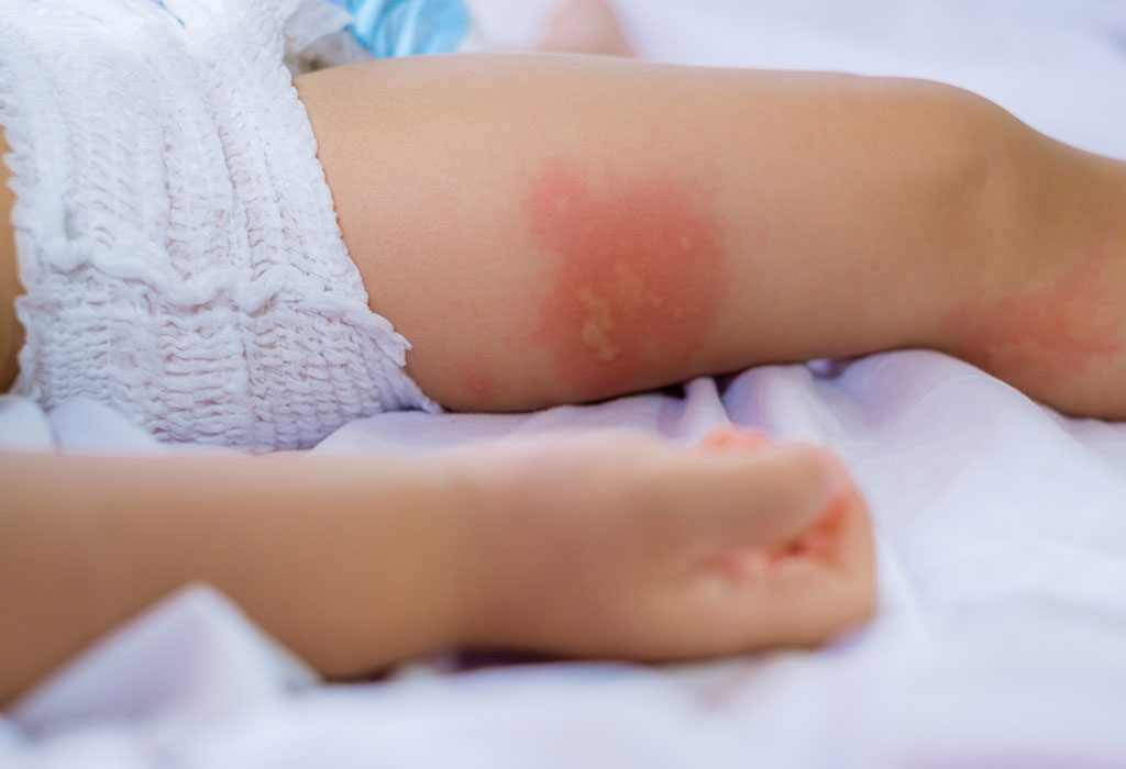 10 Useful Home Remedies For Baby Eczema