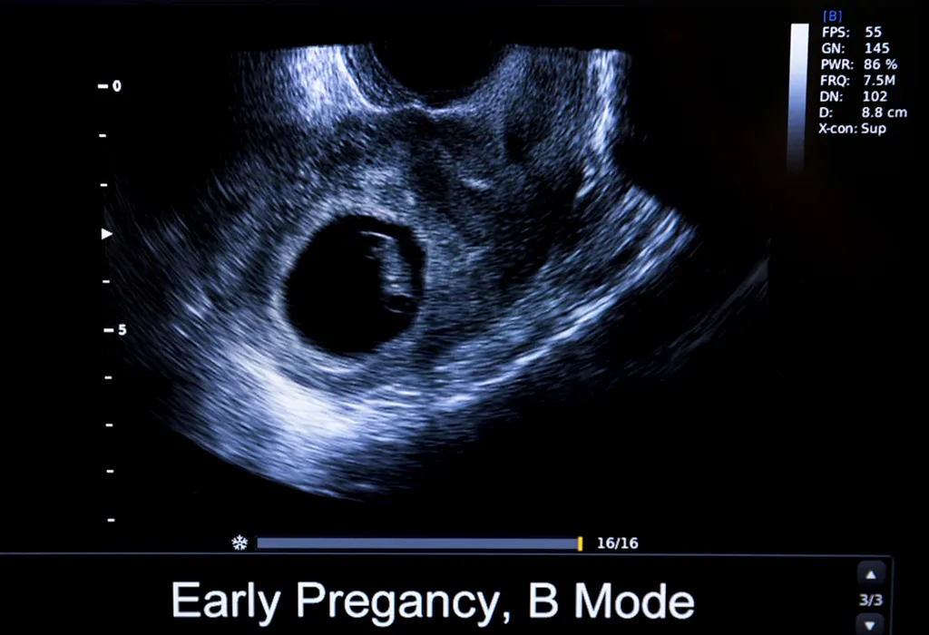 Empty pregnancy sac with Question: Can