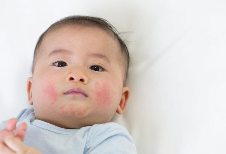 Teething Rash in Babies – Causes and Home Remedies