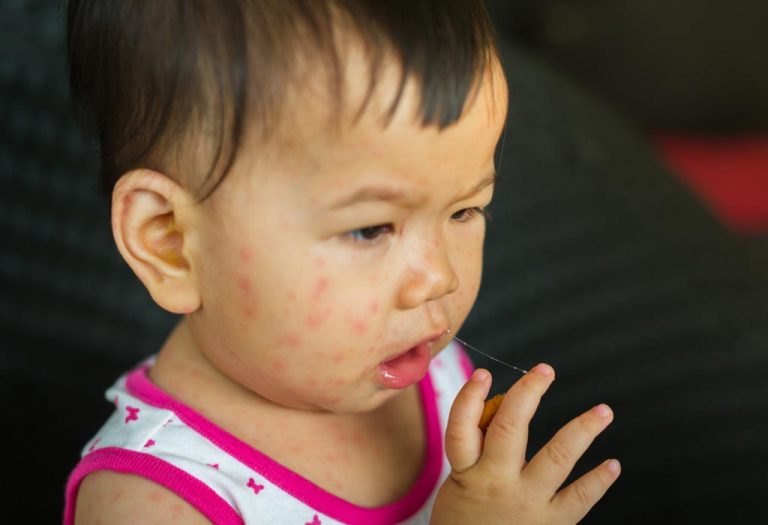 Measles (Rubeola) in Babies