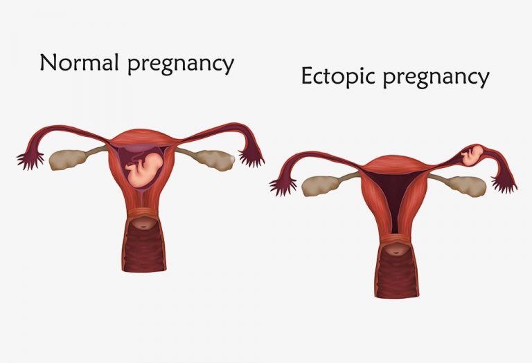 Heterotopic Pregnancy